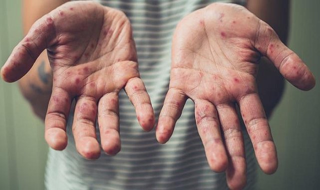 Deride pul pul dökülme ile kendini gösteriyor! Uzman isimler büyük tehlikeye karşı uyardı