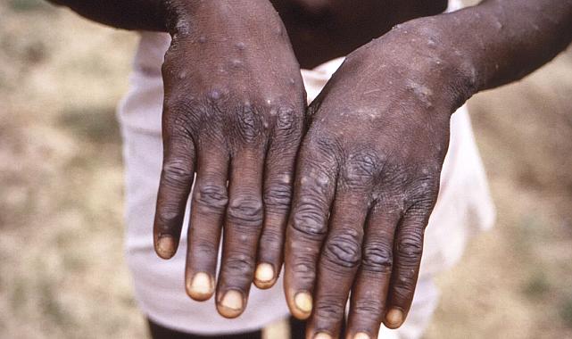 Afrika'da maymun çiçeği salgını: Acil durum ilan edildi