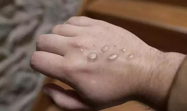 Pakistan Sağlık Bakanlığı, Körfez ülkelerinden dönen bir hastada maymun çiçeği virüsü tespit edildiğini doğruladı