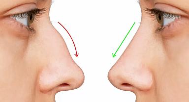 Septum Deviasyonu Sanıldığı Kadar Masum Değil