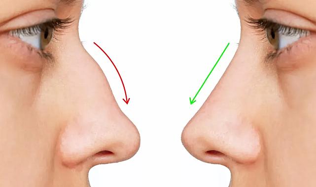 Septum Deviasyonu Sanıldığı Kadar Masum Değil