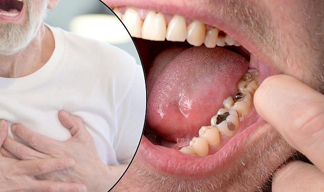Diş Çürüğü Ölümle Sonuçlanabilir! Uzman Kardiyologdan Hayati Uyarı