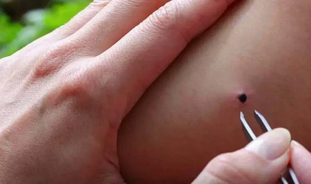 İstanbul ve İzmir’de kene vakaları iklimle birlikte arttı