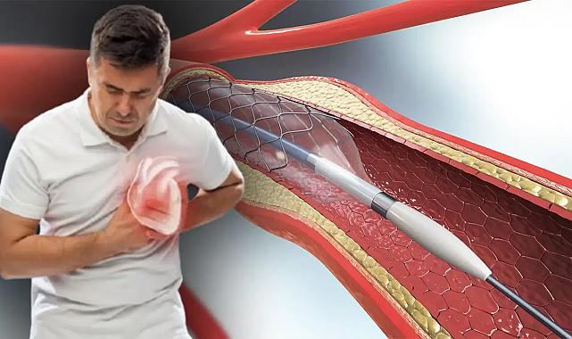 Kalp tedavisinde ilaçlı balon ve stent kullanımı farkı