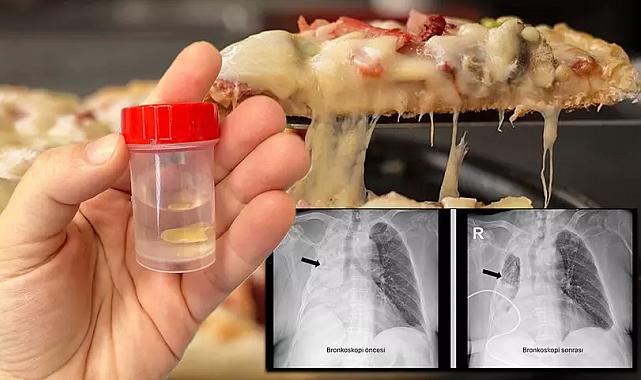 Mısır tanesi akciğerine kaçtı, 5 ay sonra fark edildi