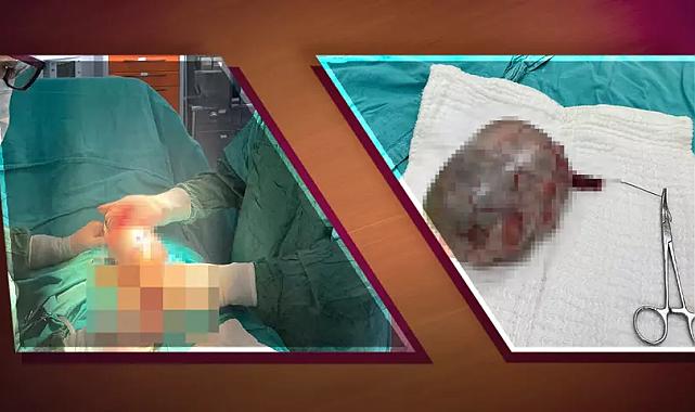 Testisten 20 cm’lik dev tümör çıkarıldı, hasta şikayetini gizlemiş