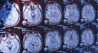 Alzheimer’da erken teşhis artık mümkün 