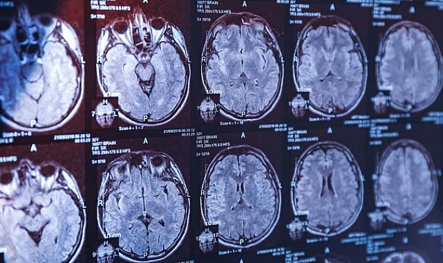 Alzheimer’da erken teşhis artık mümkün